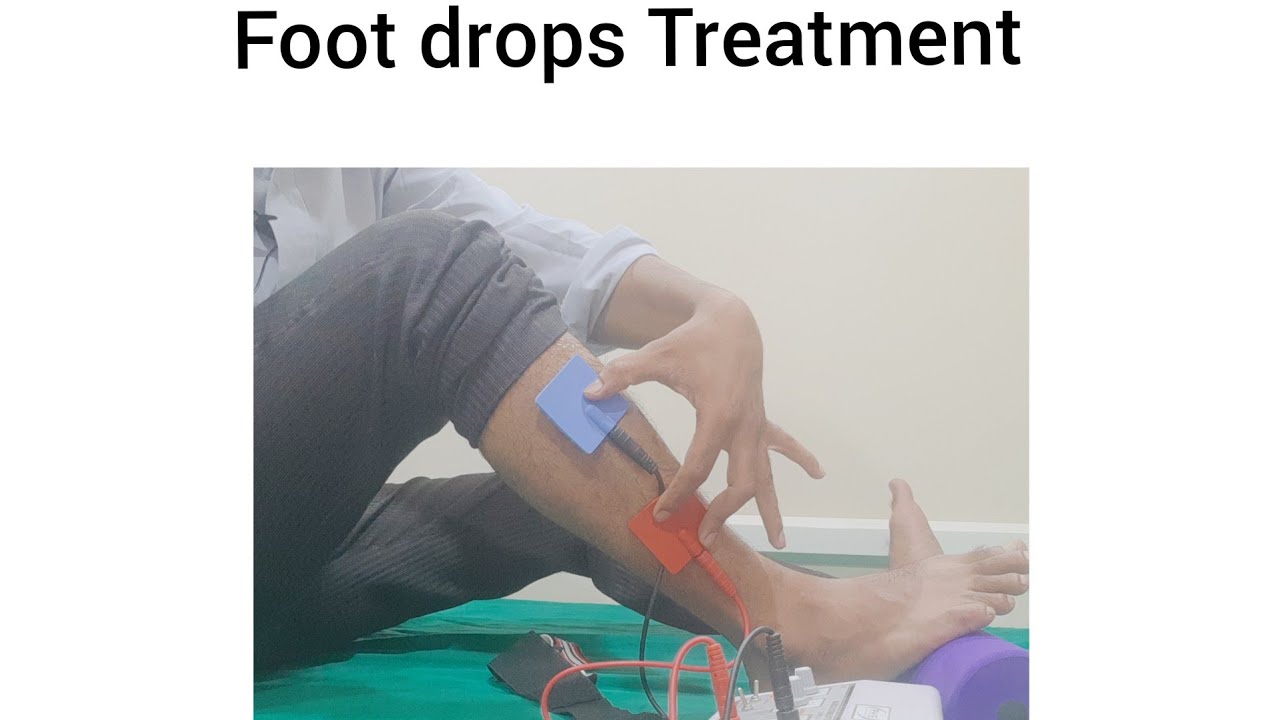 foot drop treatment/electrical stimulation/functional electrical stimulation/PhysiotherapyTreatment