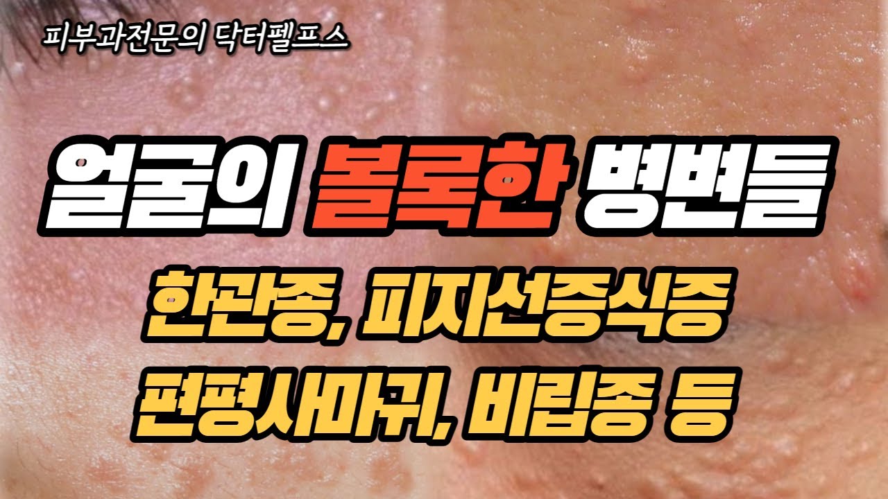 얼굴의 볼록한 병변을 구분해주세요 (한관종, 피지선증식증, 편평사마귀, 검버섯, 비립종, 좁쌀여드름)