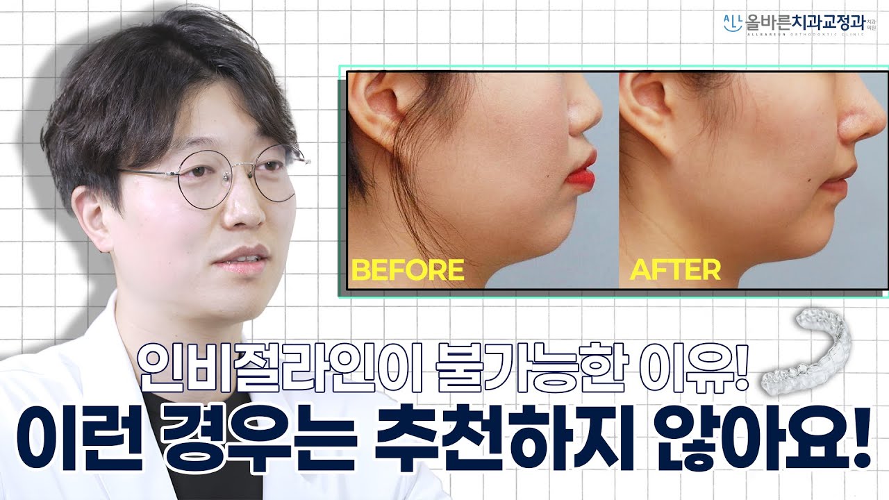 이런 경우는 '인비절라인' 추천하지 않습니다. 🦷