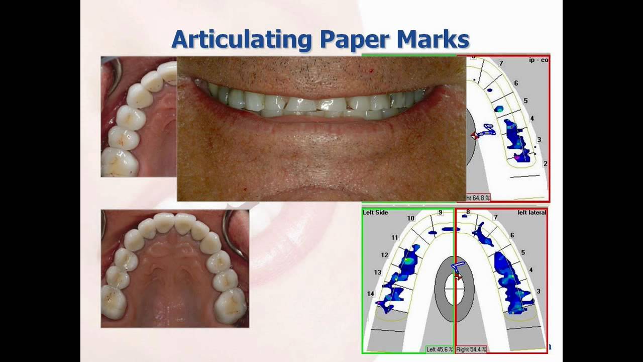 What is the T-Scan™ Computerized Occlusal Analysis System?