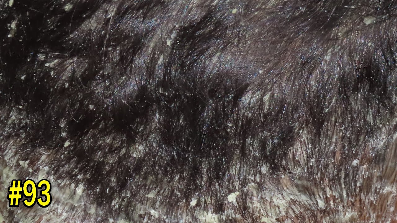 Remove Big Dandruff Flakes On Front Side #94