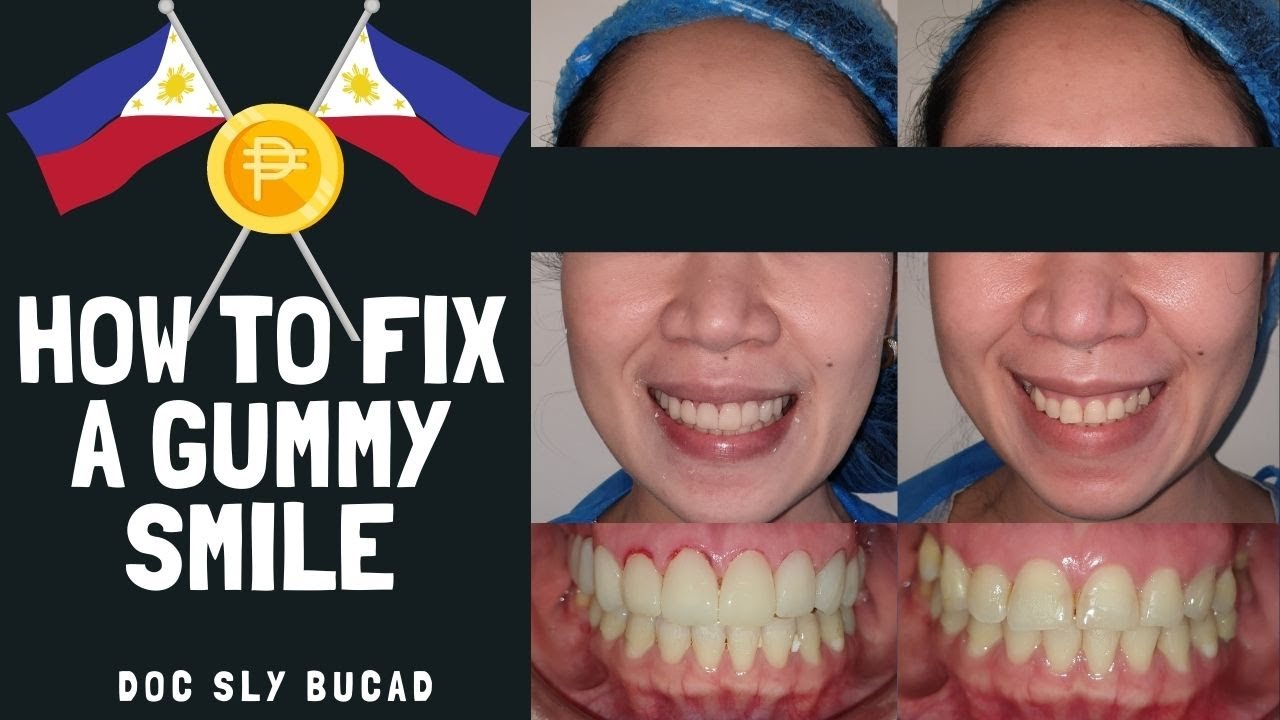 How to fix Gummy Smile Best Dental Optical Clinic Manila Philippines
