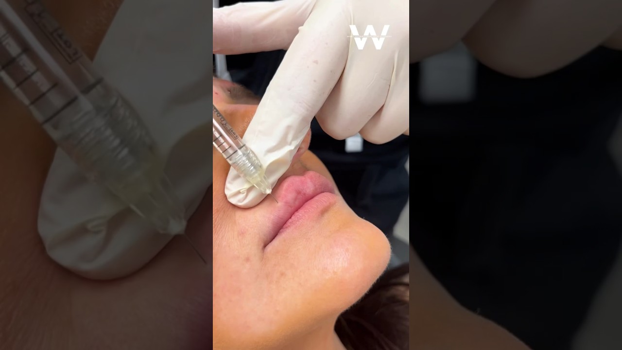 Before and after: Restylane Kysse Lip Fillers. Give your lips a natural plump with lip filler!