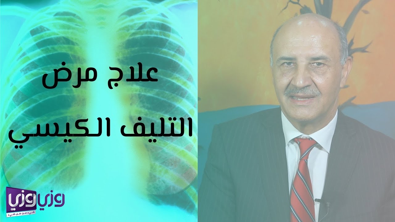 علاج مرض التليف الكيسي