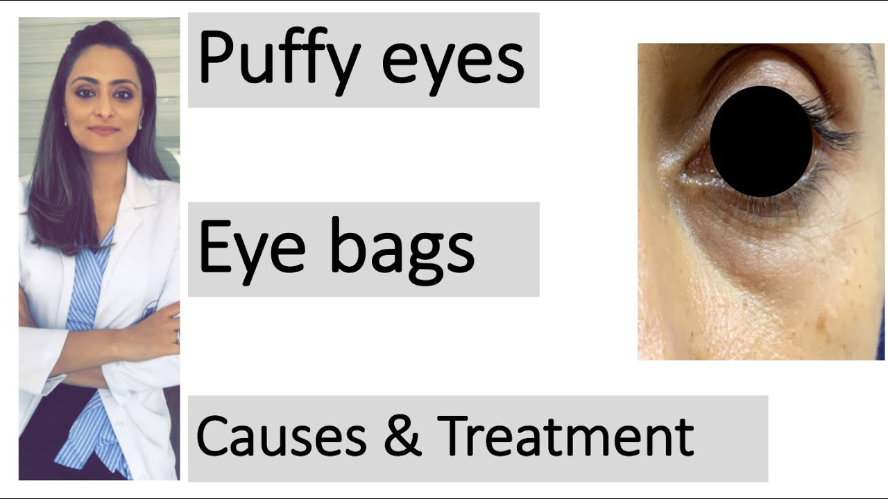 How to treat puffy eyes/ eye bags ? Causes | Treatment | creams | fillers |dermatologist| Dr.Aanchal