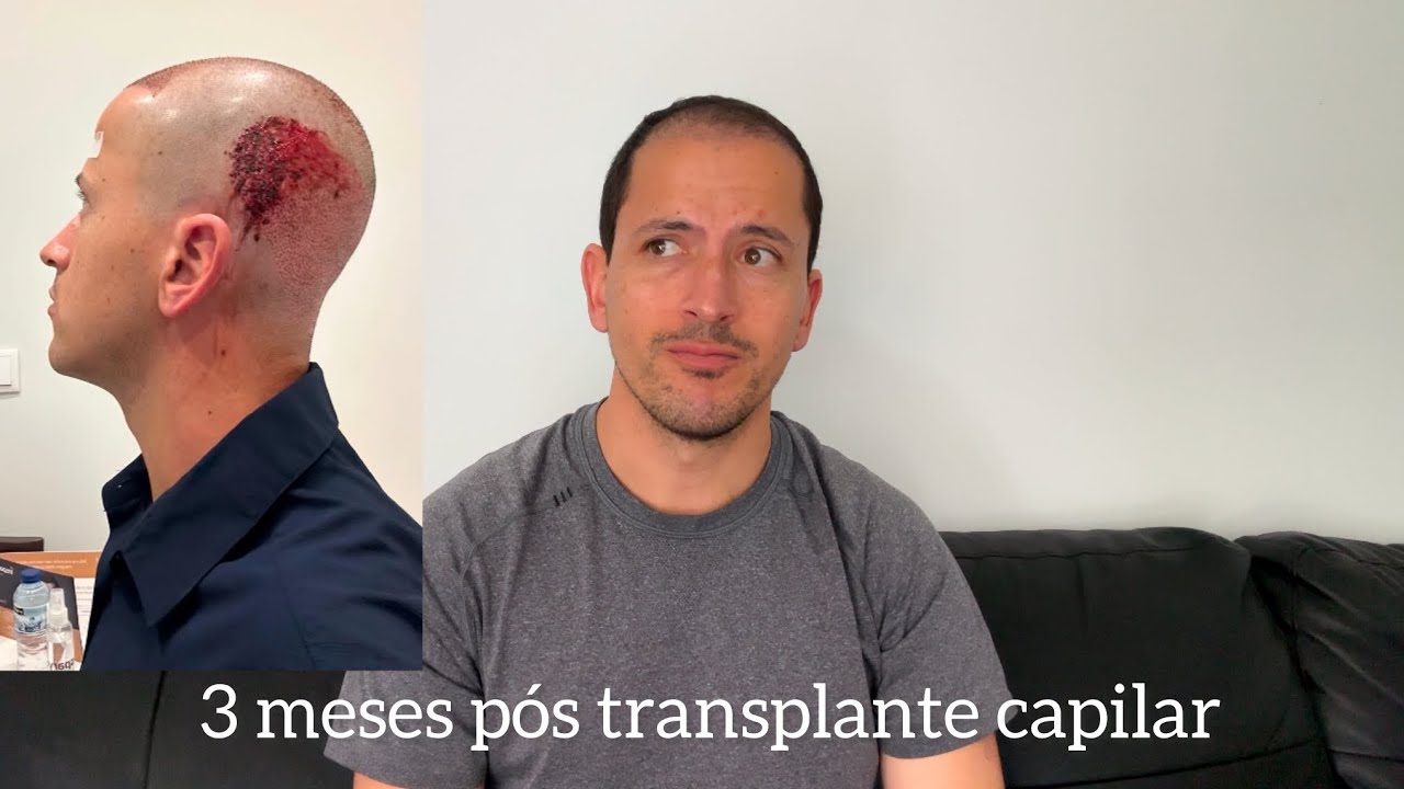 3 meses pós transplante capilar