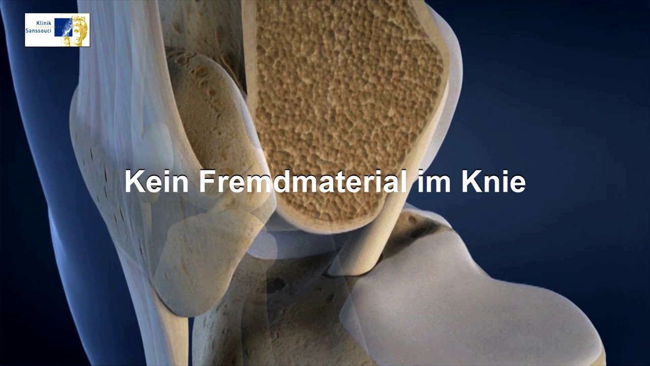 Knie OP bei Kreuzbandriss | 3D-Animation Kniegelenk