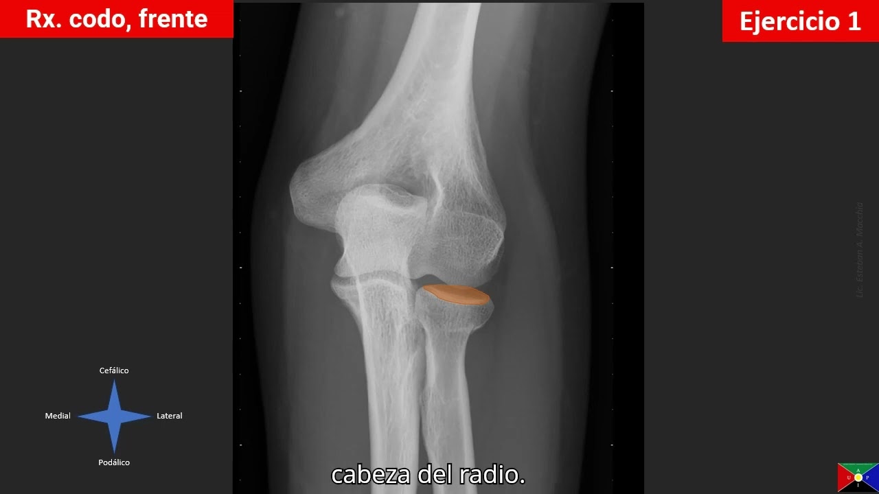 Articulación del codo  en radiografía - estructuras óseasCST