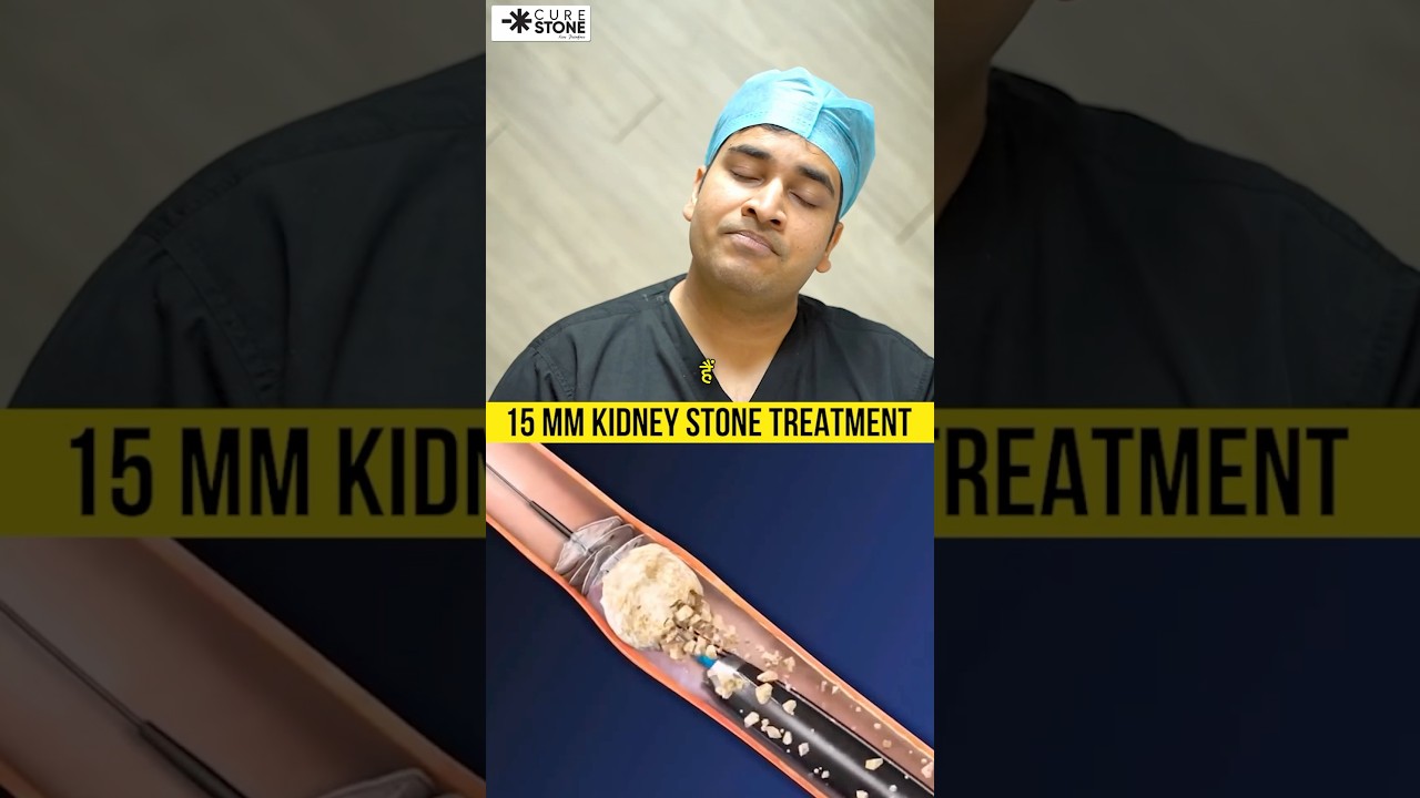 15mm Kidney stone treatment