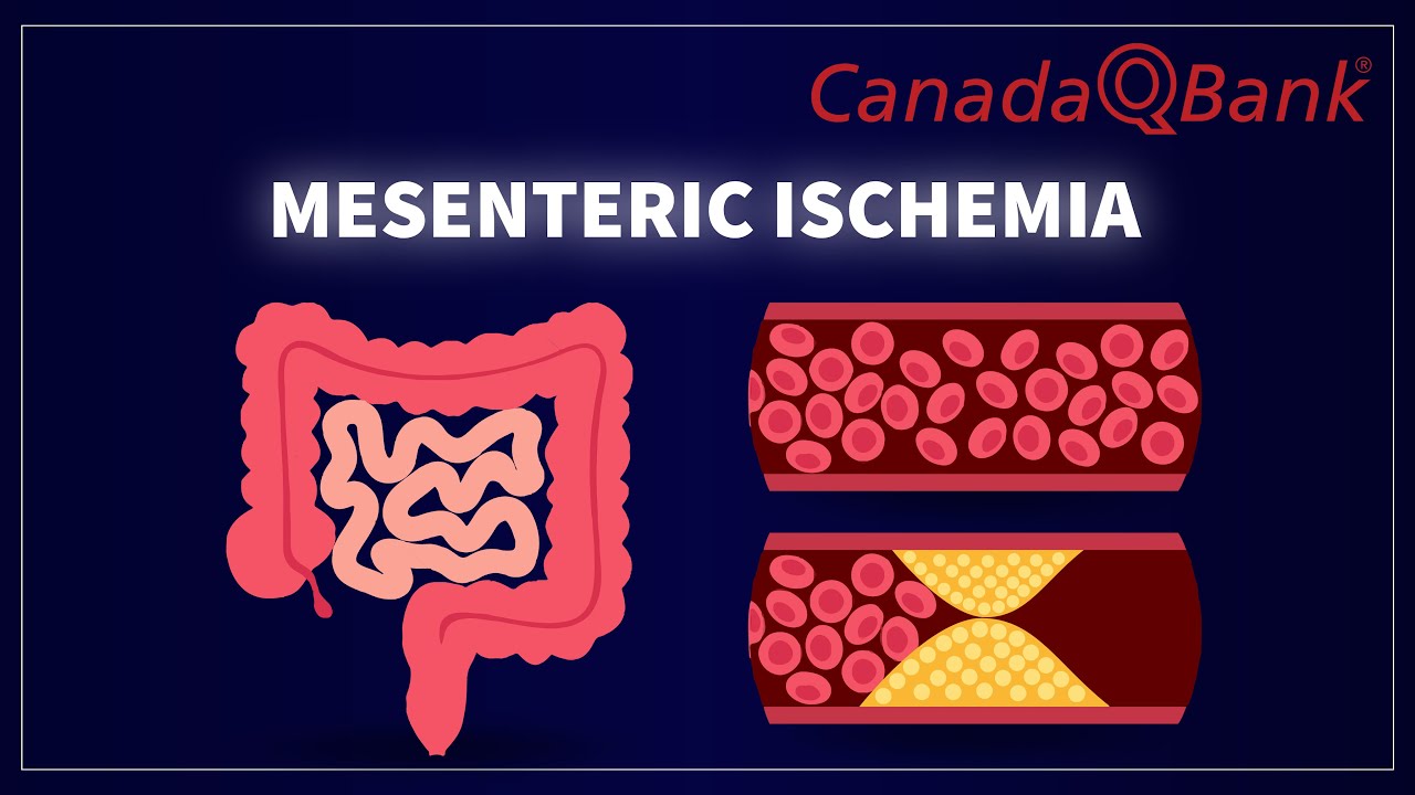 Mesenteric Ischemia: Causes, Symptoms & Treatment | Acute Abdomen Explained | CanadaQBank