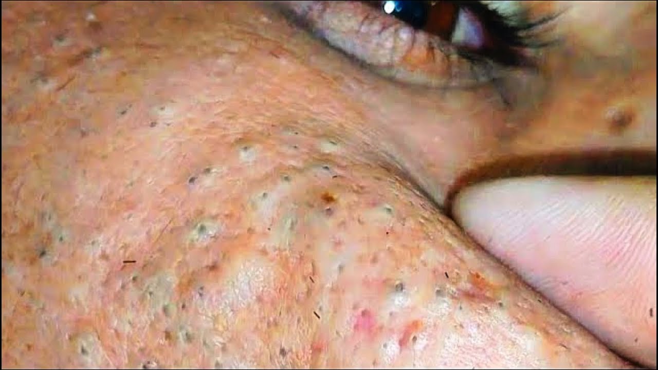 sac be spa blackheads elderly new | sac be spa men age blackheads new 2026 | sac be spa face scrub 
