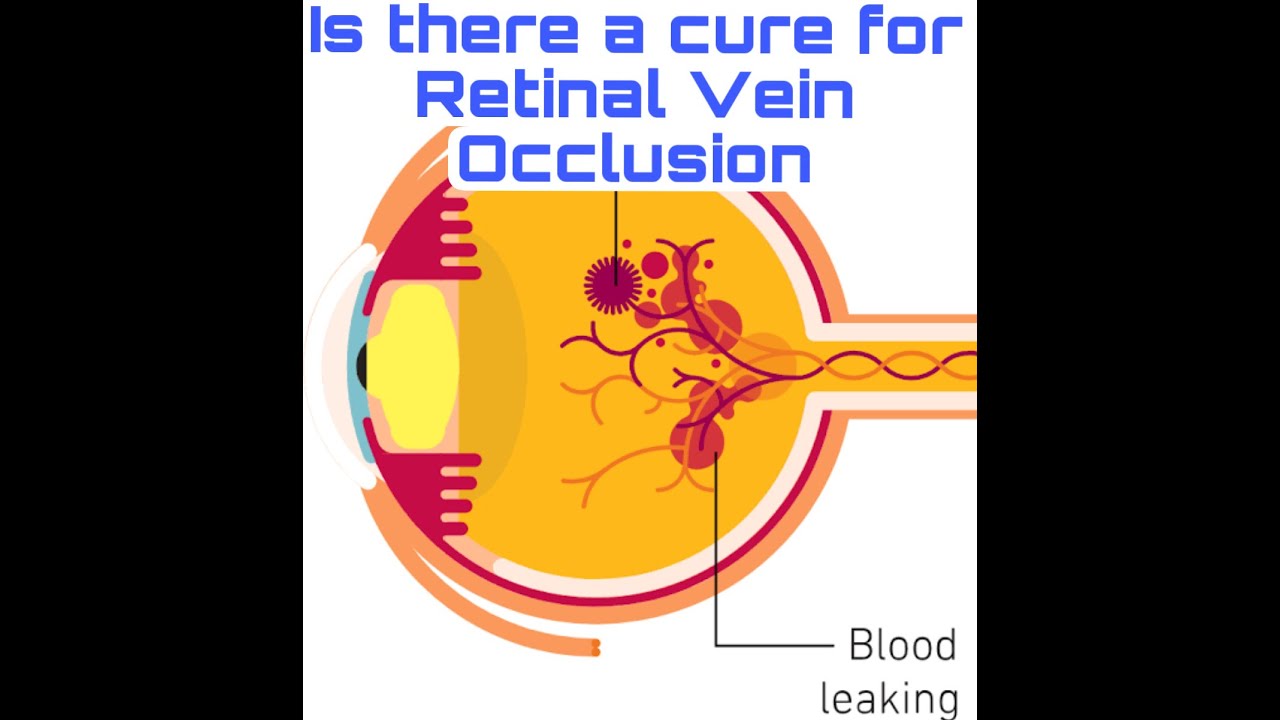 Is there a cure for Retinal Vein Occlusion/ #eyestroke