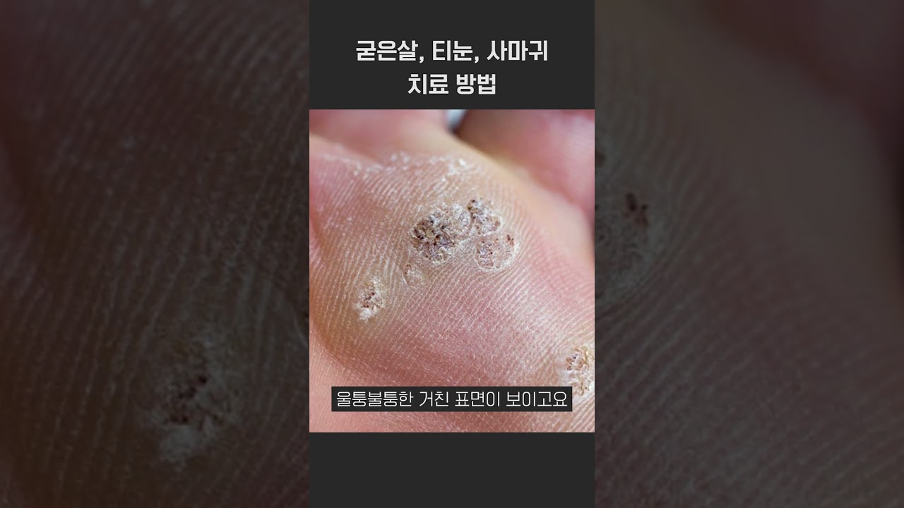 티눈, 굳은살, 사마귀 차이점과 치료 방법은? #shorts