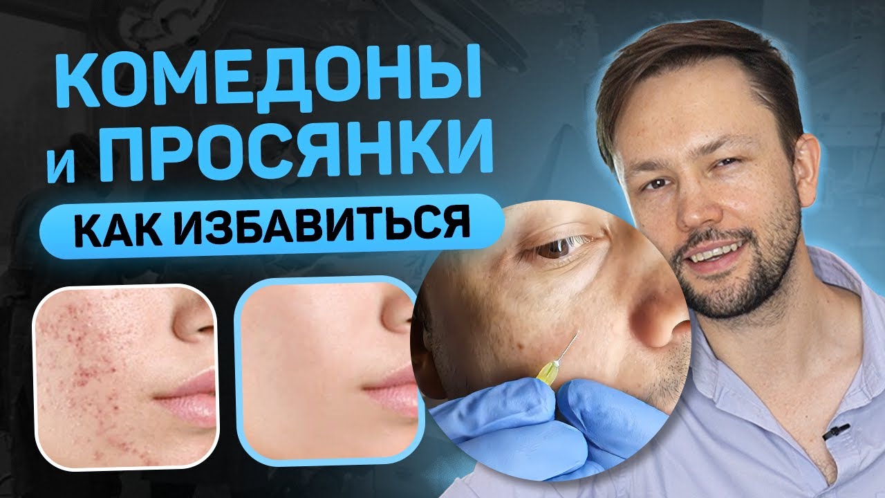 Комедоны и просянки. Удалить без косметолога.