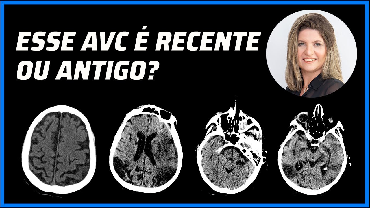 COMO É A EVOLUÇÃO DO AVC NA TOMOGRAFIA COMPUTADORIZADA