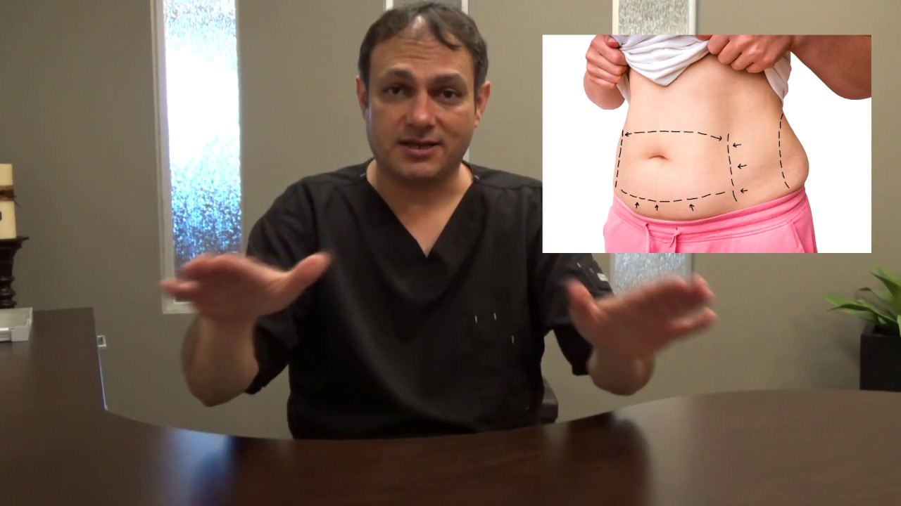 Should I get liposuction or a tummy tuck?