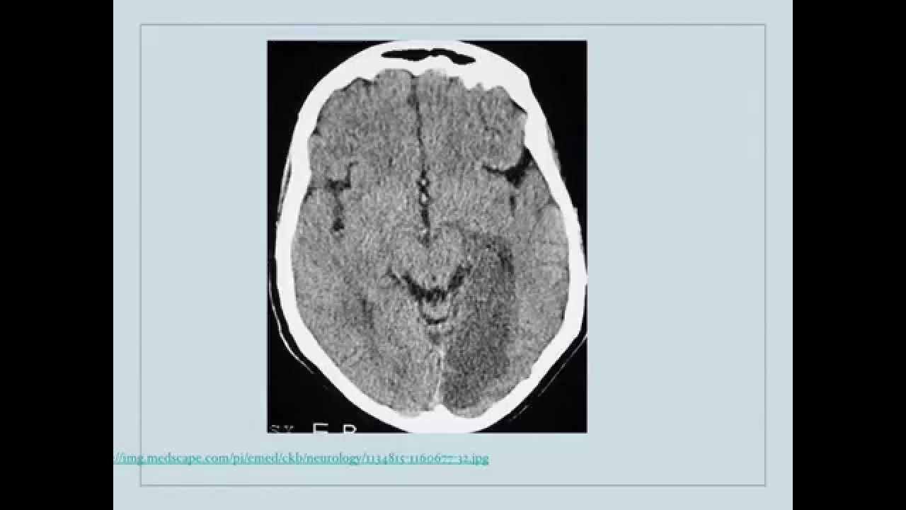 Clinical Pearls in Cerebrovascular Disease Neurology