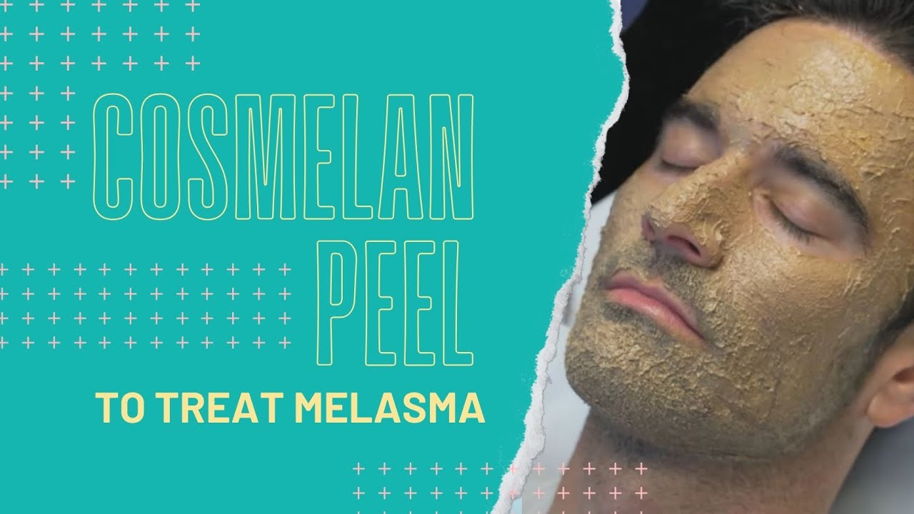 Cosmelan Peel to Treat Melasma | Dr. Jason Emer