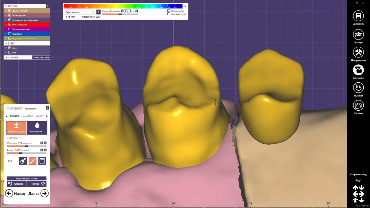 Exocad моделировка каркаса под 3D печать