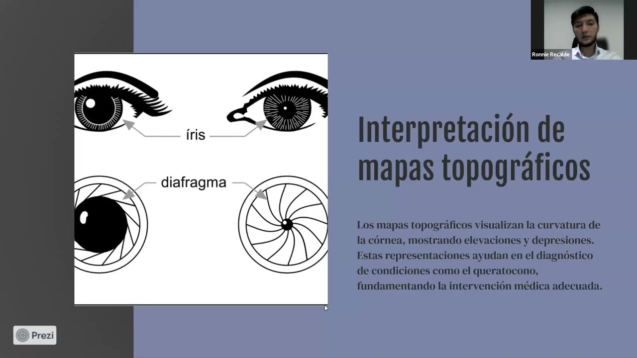 Pentacam ®, Aplicaciones clínicas en optometría | santiago bonilla