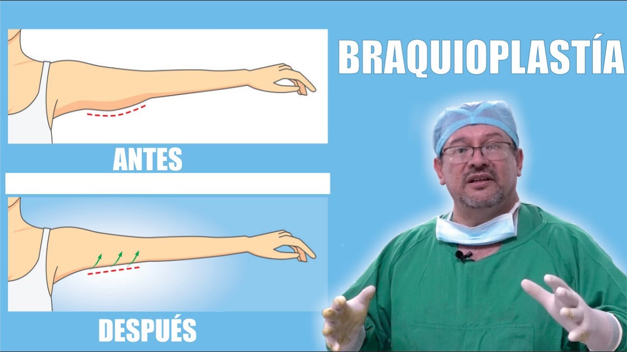 BRAQUIPLASTÍA y LIPO de BRAZOS 💪🏼 ALAS de MURCIÉLAGO 💪🏼 BRAZOS HERMOSOS 🩺 Dr ALBERTO CALVO QUIROZ