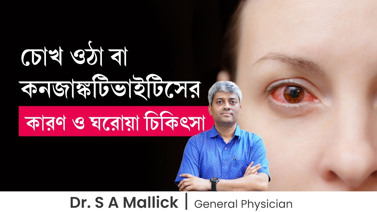 কনজাঙ্কটিভাইটিস বা চোখ ওঠার কারণ ও ঘরোয়া চিকিৎসা | Conjunctivitis: Causes & Management