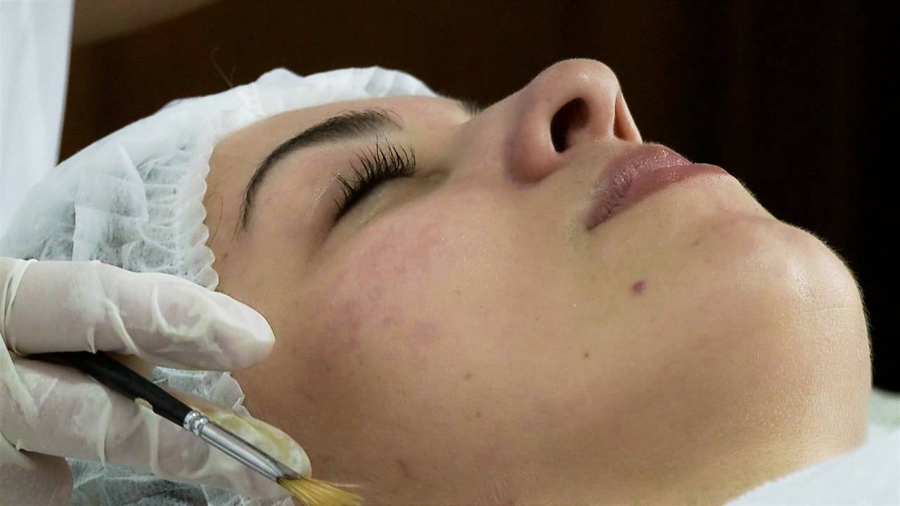Curso Online de Peelings Faciais