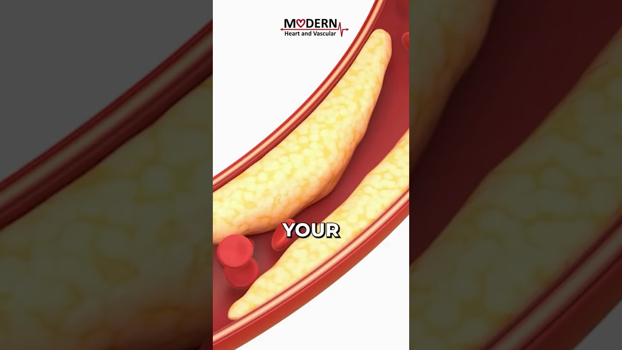 PAD and the Risk of Heart Attack or Stroke.