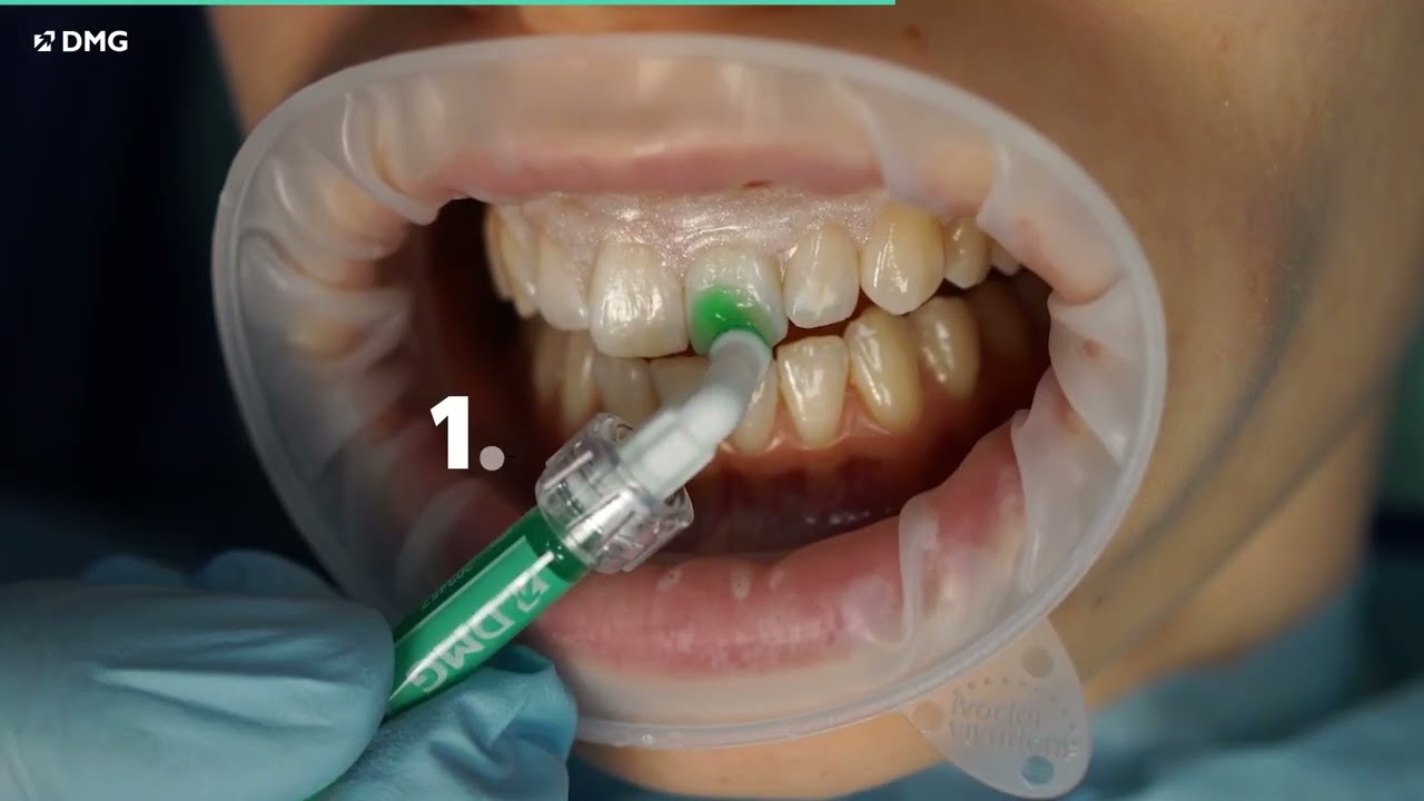 Icon Vestibular by DMG: Effective treatment of White Spots (swe)