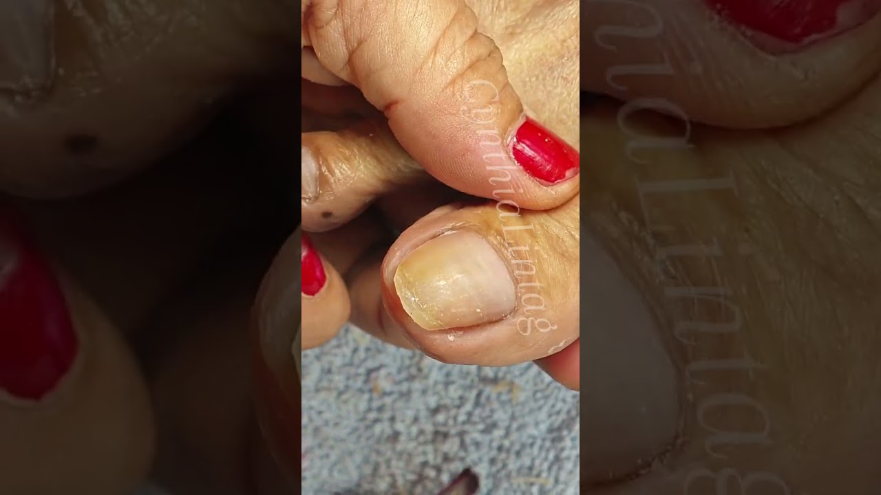Full video pedicure with ingrown removal 