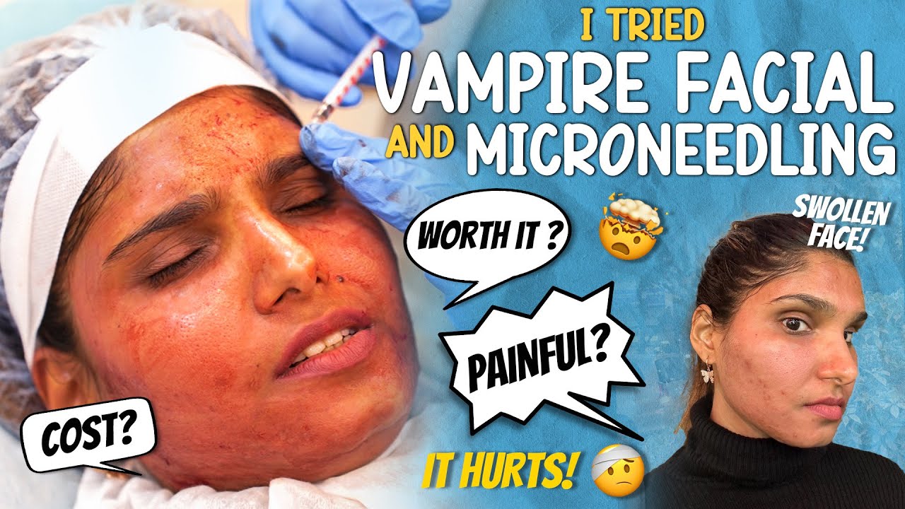 I got VAMPIRE FACIAL DONE | SWOLLEN | EXACT AMOUNT ?