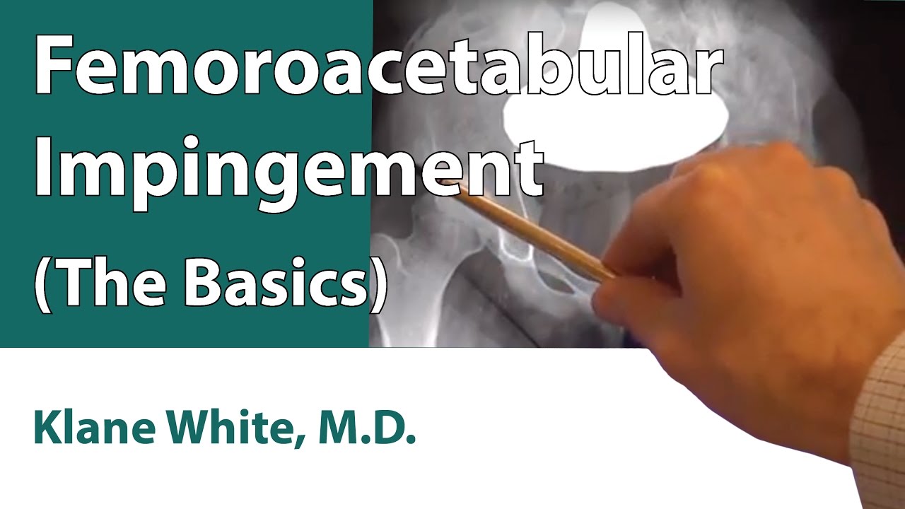 Femoroacetabular Impingement (The Basics)