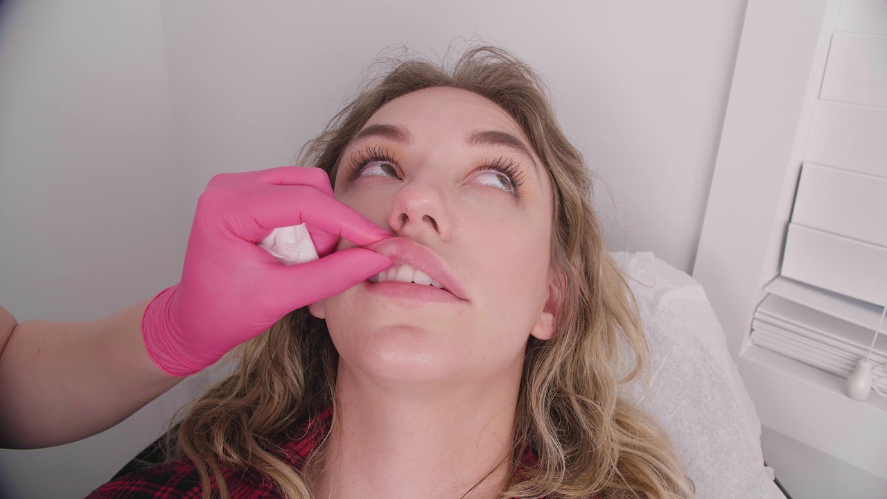 LIP INJECTIONS | SEV LASER