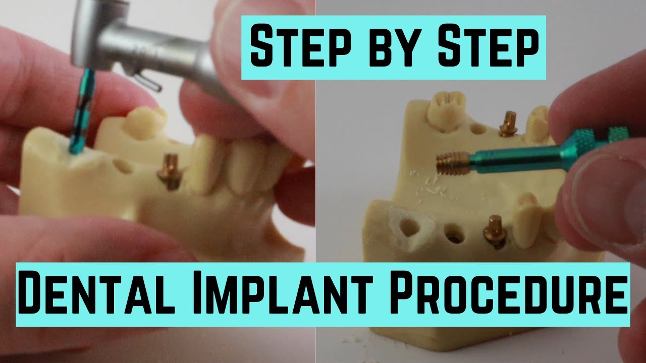 How to place a dental implant step by step in a plastic model, no blood.