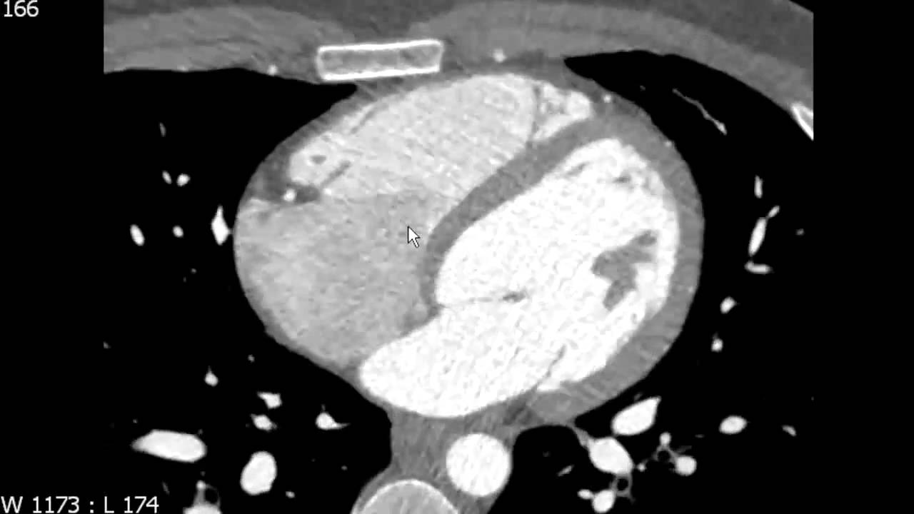 Right Atrial Anatomy on Axial Cardiac CTA