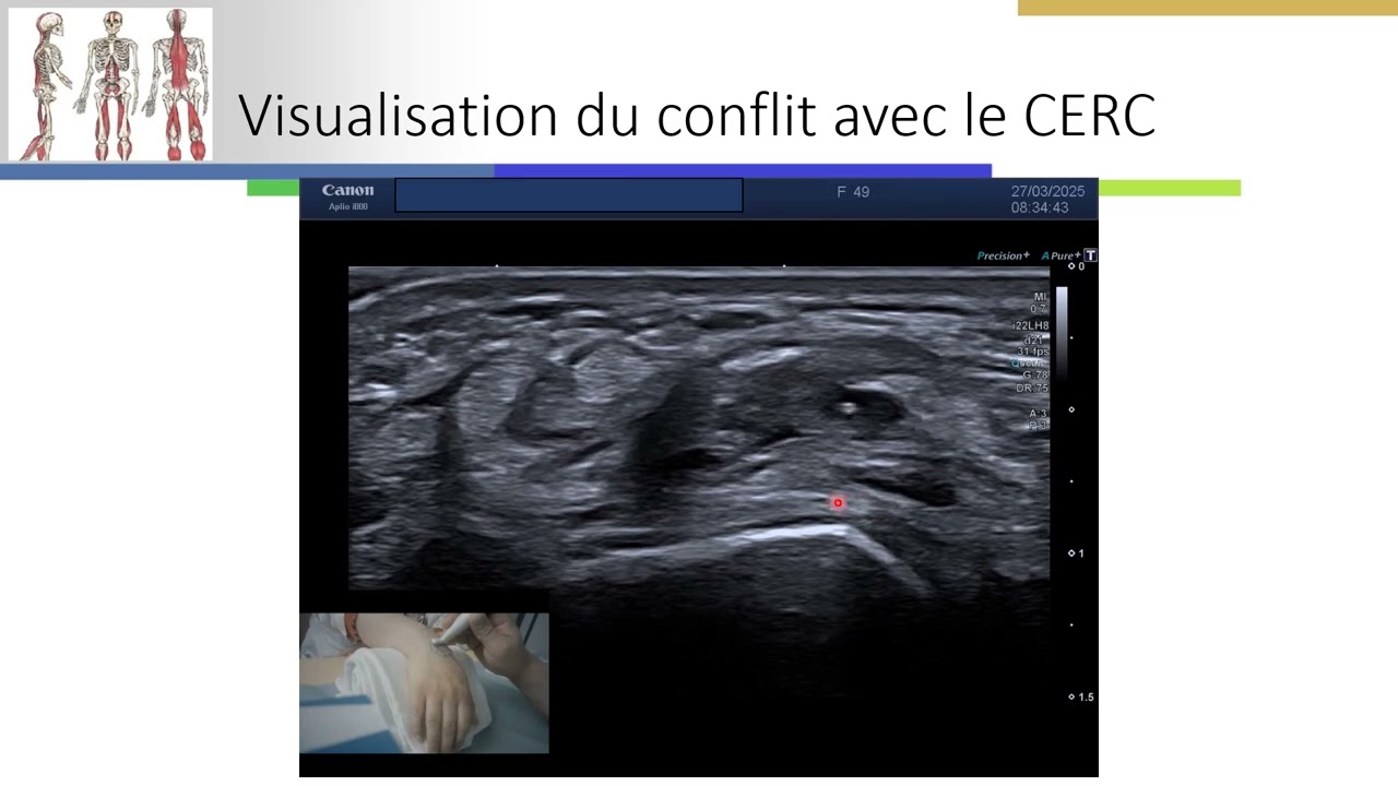 Kyste de la face dorsale du poignet: aspect échographique
