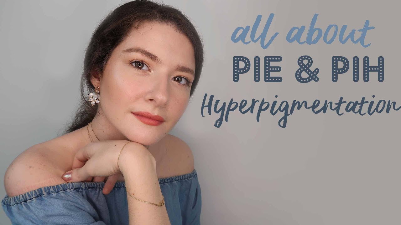 Cilt lekeleri nasıl iyileşir? │ Güneş lekeleri ve sivilce izleri için öneriler 🙅🏻‍♀