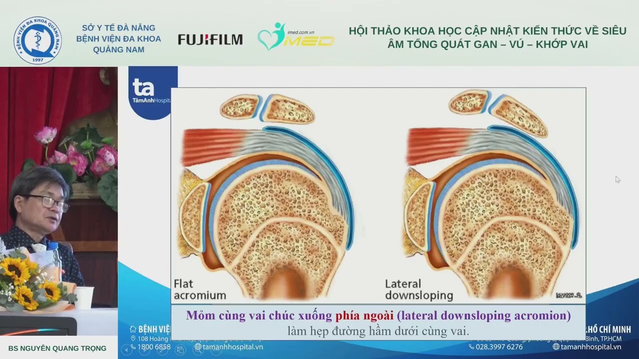 5. Cập nhật si&ecirc;u &acirc;m khớp vai (BS Nguyễn Quang Trọng)