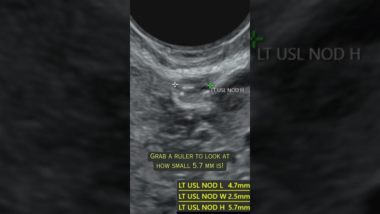 #Endometriosis may be small sometimes, but that doesn&rsquo;t mean it can&rsquo;t be found on ultrasound!