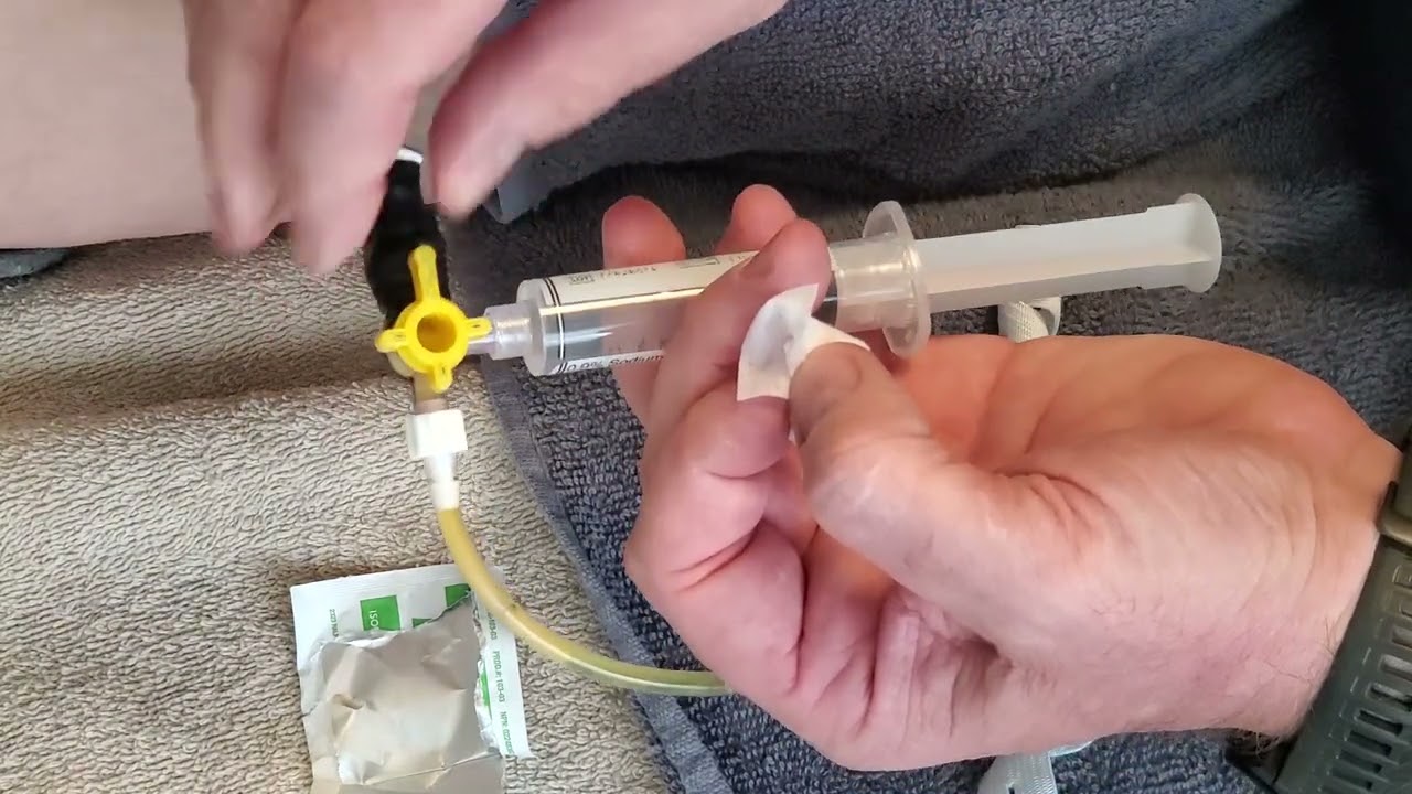 Flushing a PTC/biliary drain after liver resection.