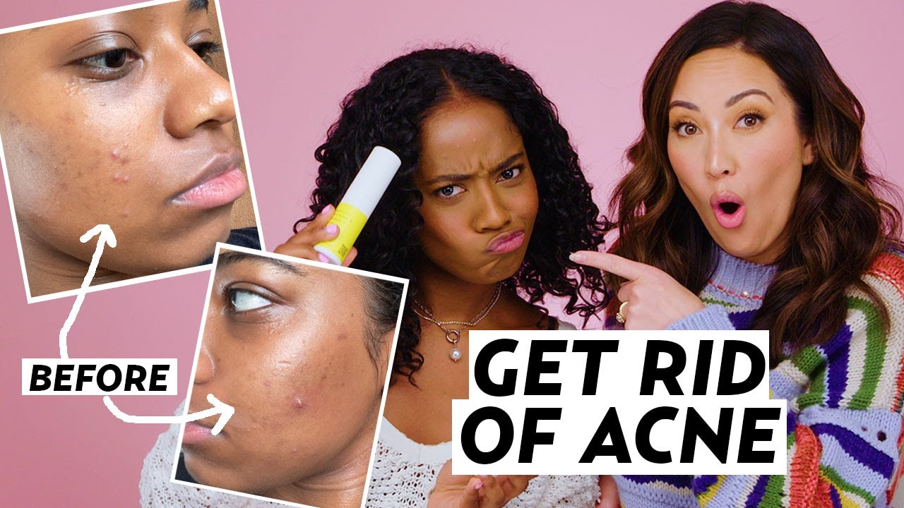6 Clear Skin Tips to Get Rid of Acne (Skincare Routine, Tretinoin, Double Cleanse, & More)