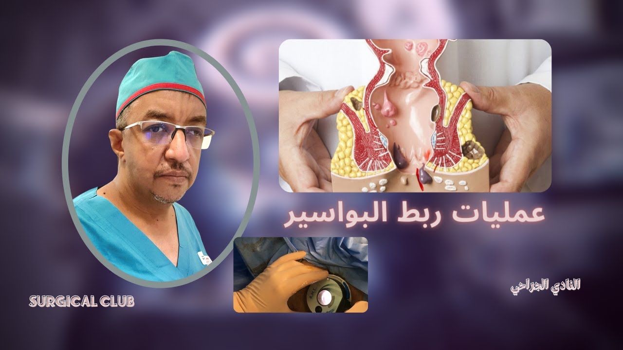 عملية ربط شريان البواسير