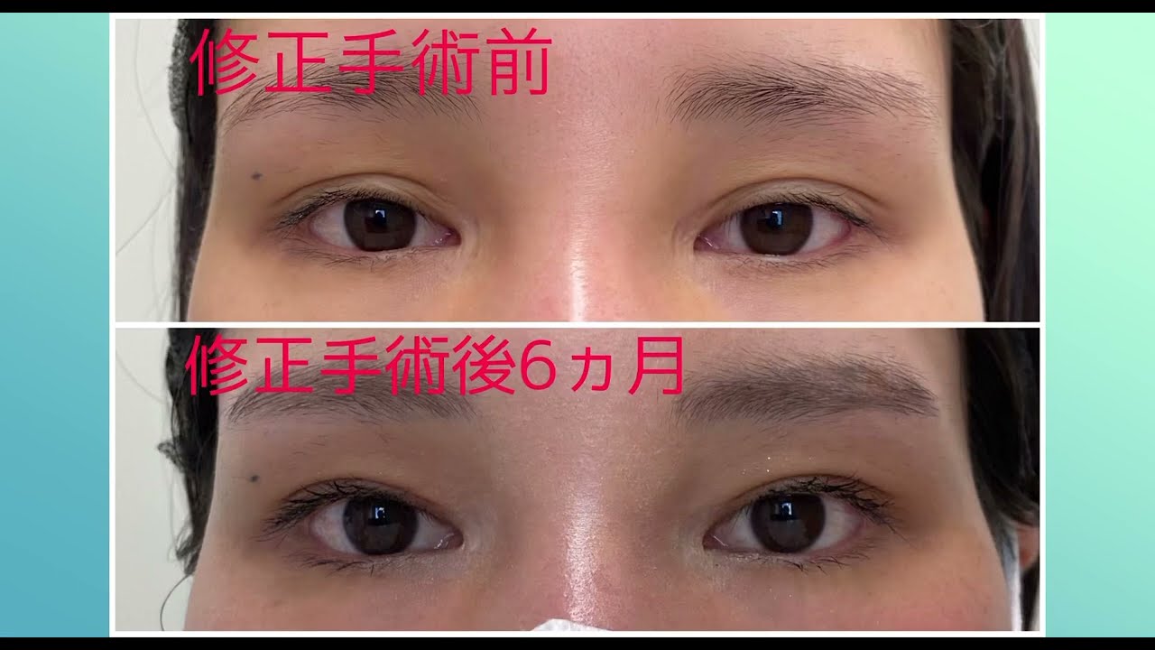 二重まぶたライン幅を狭くする。2022.08.10 1