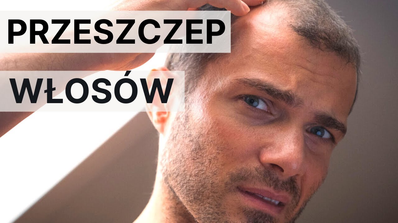 Przeszczep włos&oacute;w w Turcji z mojej perspektywy