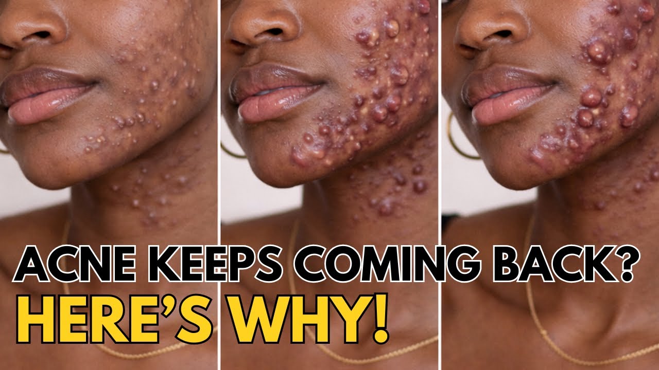 Why Acne Keeps Coming Back Even When Your Consistent | ACNE SERIES | EPISODE 3