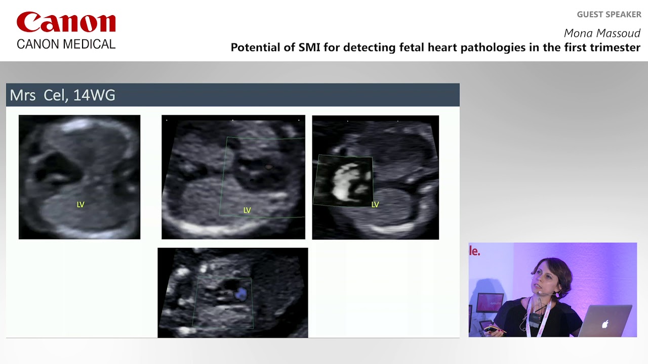 ISUOG 2019 - Mona Massoud on using SMI for detecting fetal heart pathologies in the first trimester