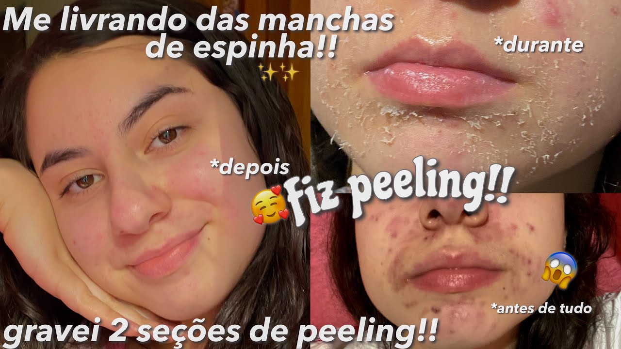 FIZ PEELING!! ME LIVRANDO DAS MANCHAS DE ESPINHA!!✨🤧