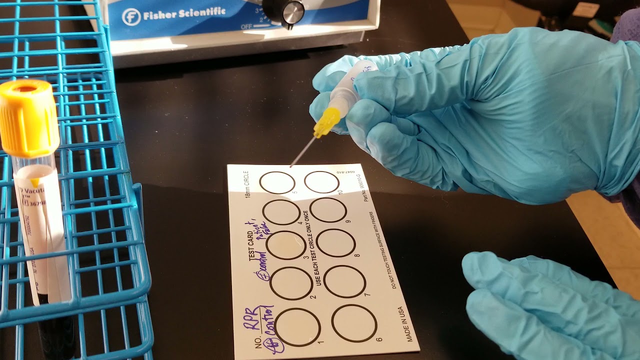 Microbiology:  Rapid Plasma Reagin (RPR) Test