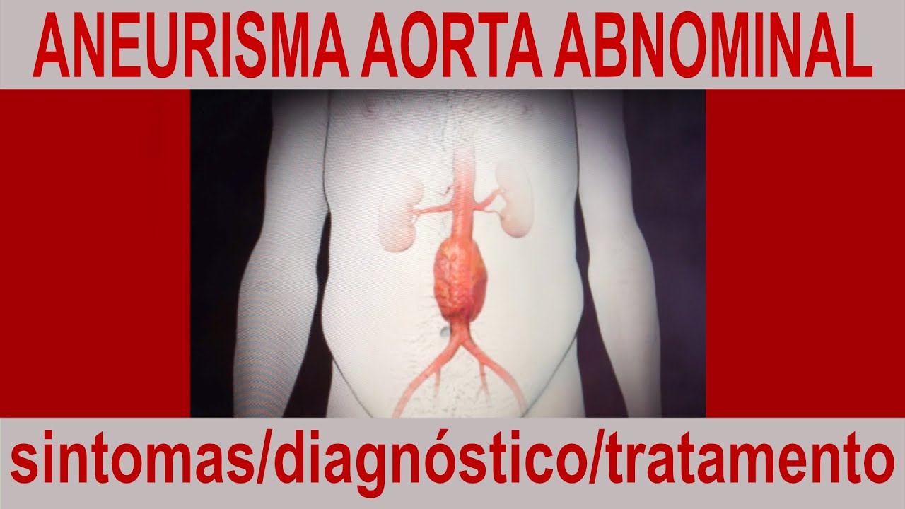 ANEURISMA NA AORTA ABDMINAL