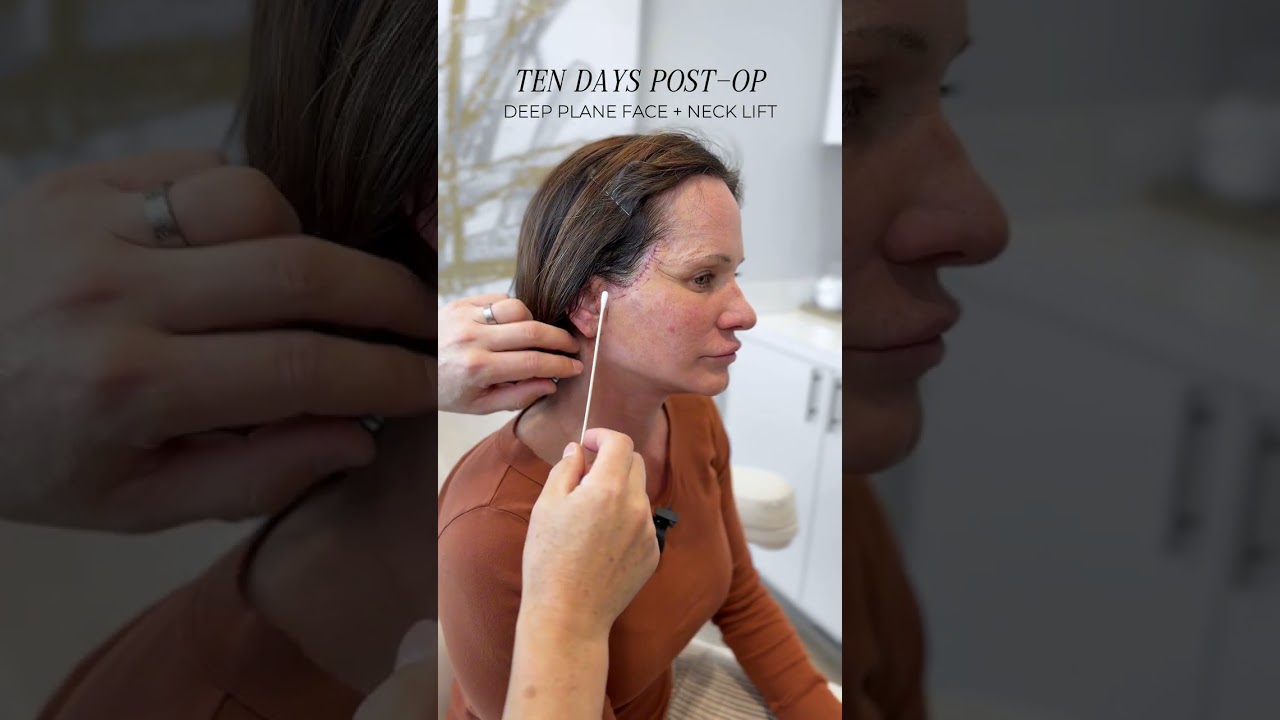 10 Days Post-Op: Stunning Early Results from the AdmireMD Deep Plane Face + Neck Lift #facelift